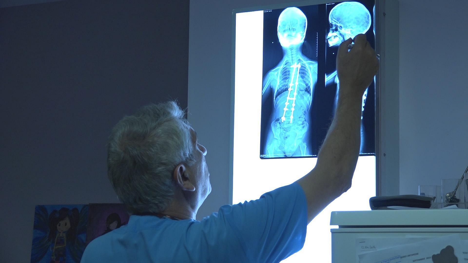 Das von Burnei montierte Shilla-Implantat
