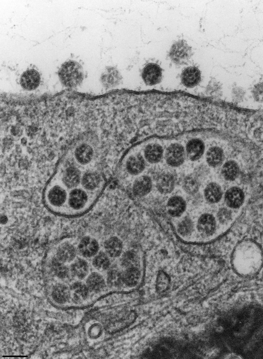 Elektronenmikroskopische Aufnahme von SARS-Viren in- und außerhalb einer Zelle 